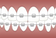 Avantajele purtarii unui aparat dentar ceramic